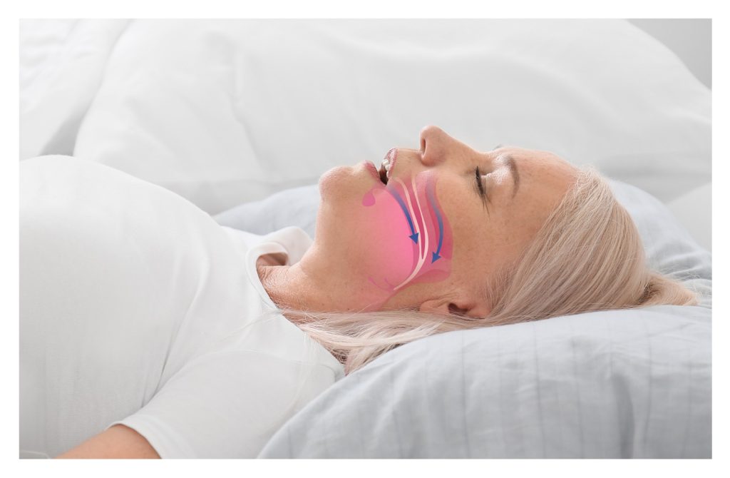 Inspire Sleep Therapy vs CPAP: Which Sleep Apnea Treatment Works Best? banner